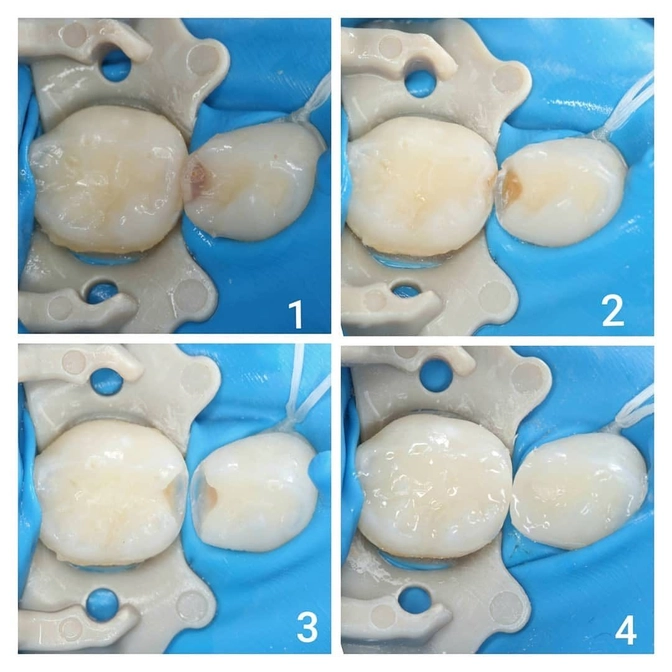 Лечение контактного кариеса молочных зубов. 