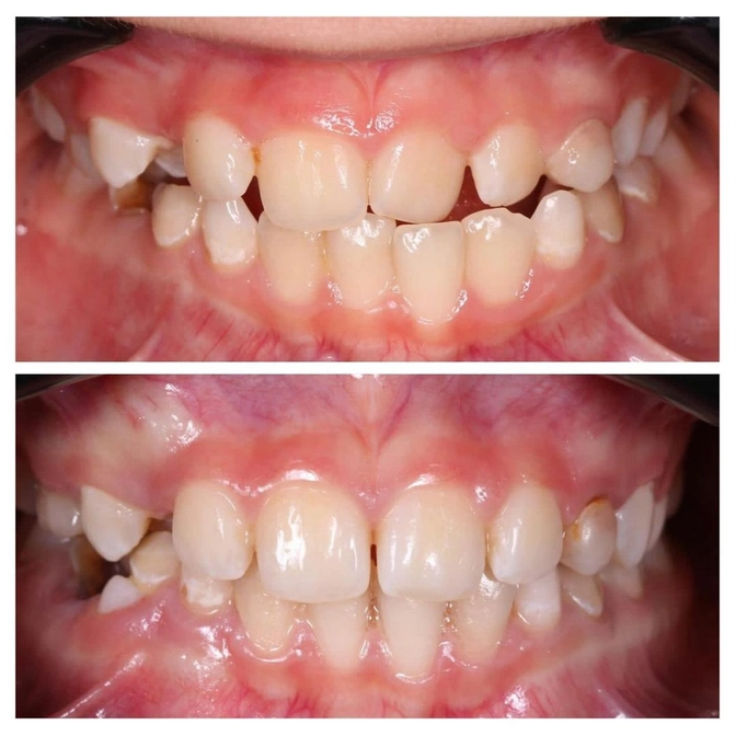 Перекрестный прикус: лечение в сменном прикусе 