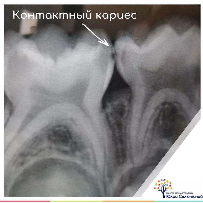 Контактный кариес: причины. 