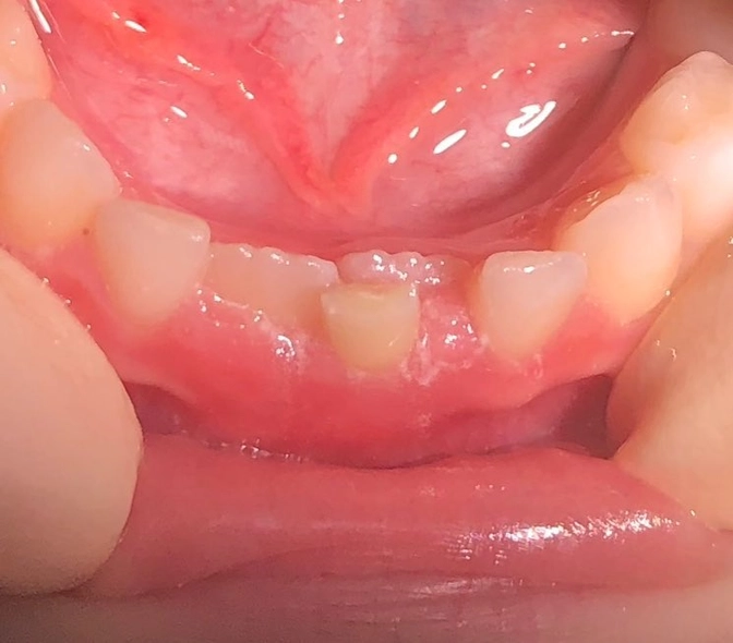 Зубы"в два ряда"?