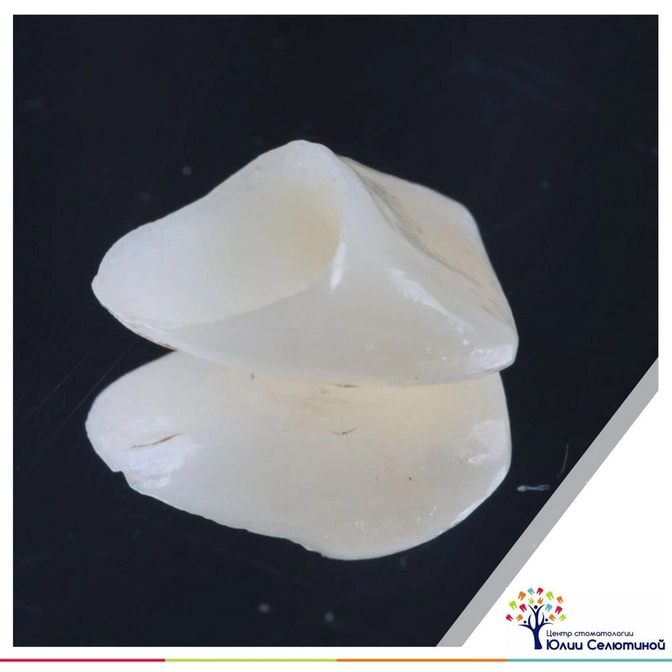 Из чего делают виниры? 