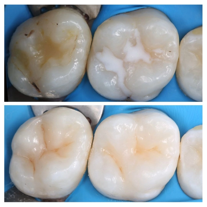 Неочевидный кариес 