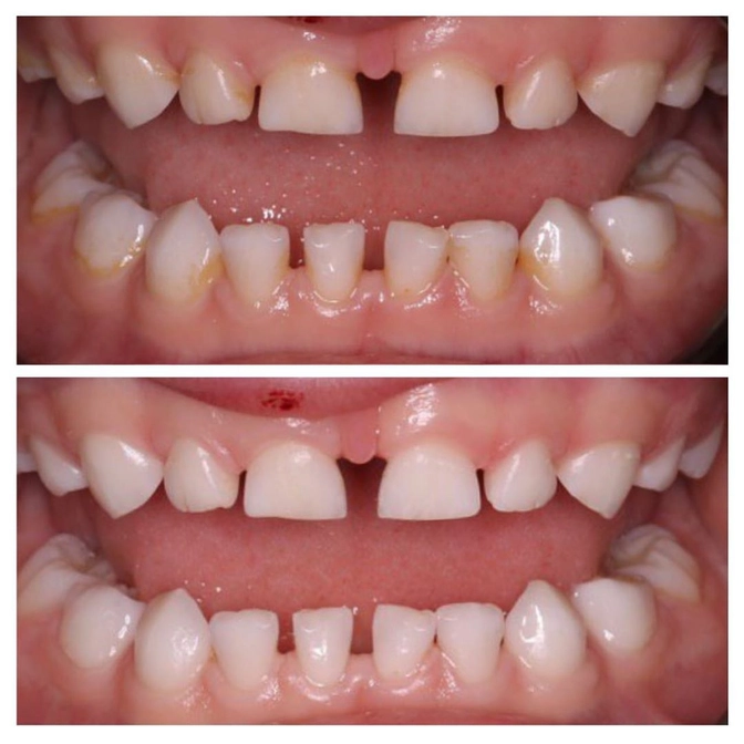 Причины пигментированного налета на молочных зубах.