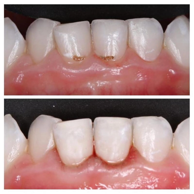 Клинический случай: необычная локализация кариеса