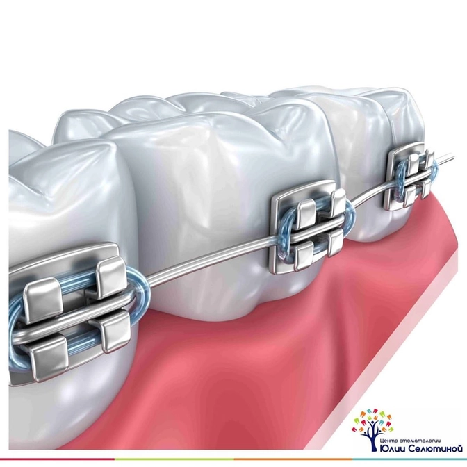 Можно ли ставить брекеты на виниры и коронки?