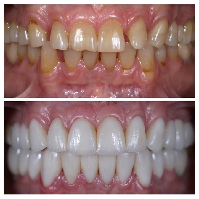 С чем ходит пациент, пока изготавливаются коронки? 