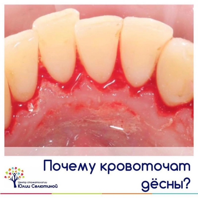Кровоточивость дёсен.