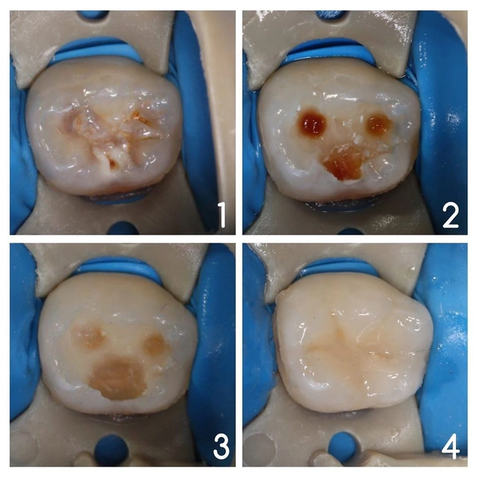 Лечение кариеса молочного зуба: почему нельзя затягивать? 