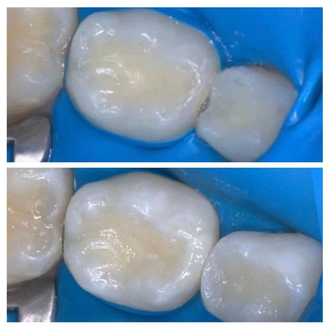 Лечение кариеса молочного зуба у ребёнка 