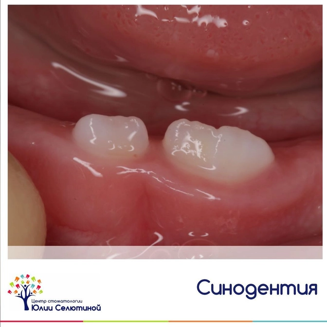 Синодентия