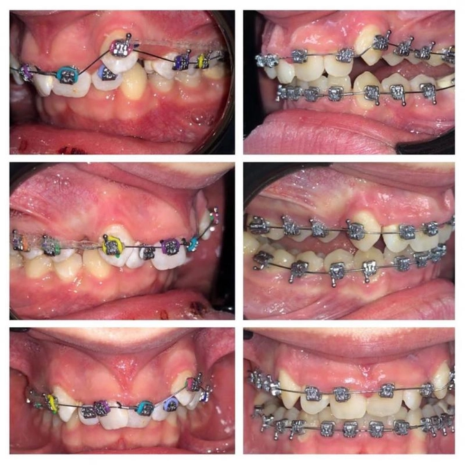 Ортодонтическое лечение: ретрузия резцов.