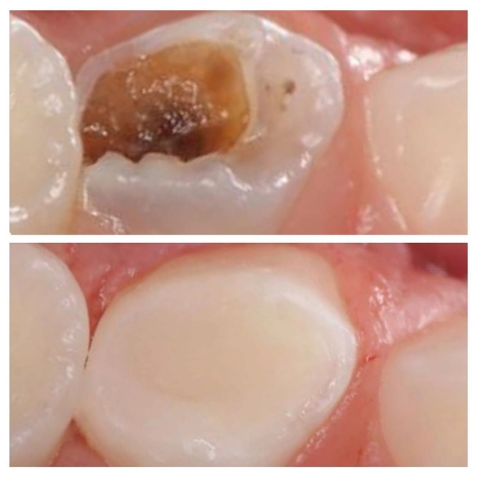 Зачем вовремя лечить молочные зубы?