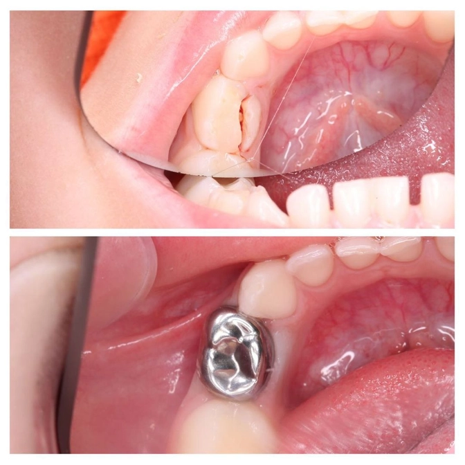 Коронки на молочные зубы.