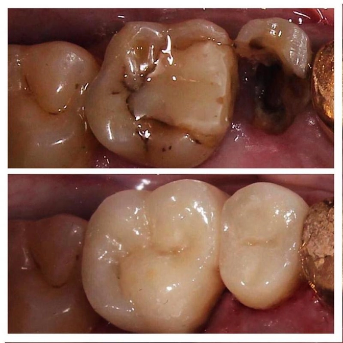Коронки и их виды.