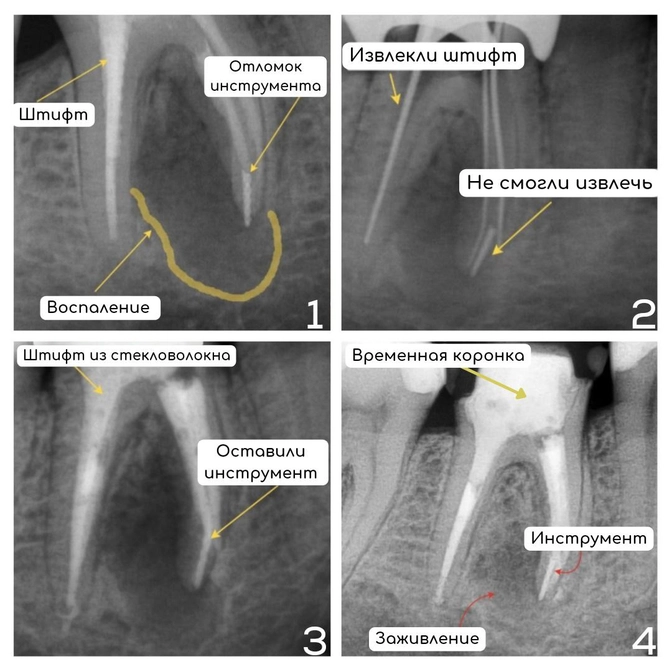 Передечиваем зуб с отломком инструмента в канале 