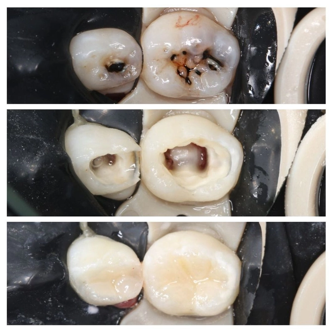 Лечение посеребренных зубов 