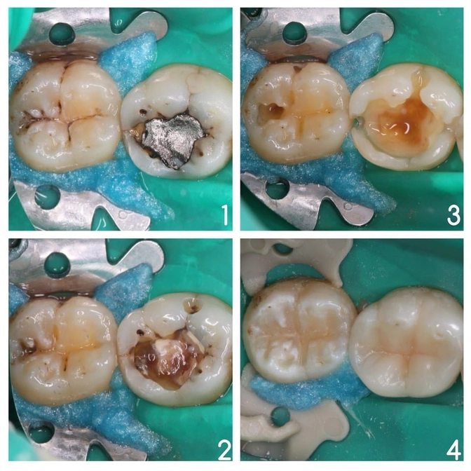 Замена старых пломб на новые. 