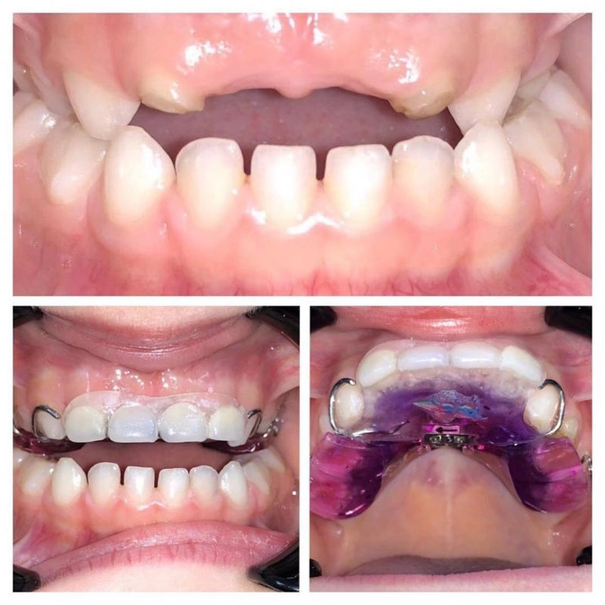Заместительная пластинка при отсутствии резцов.