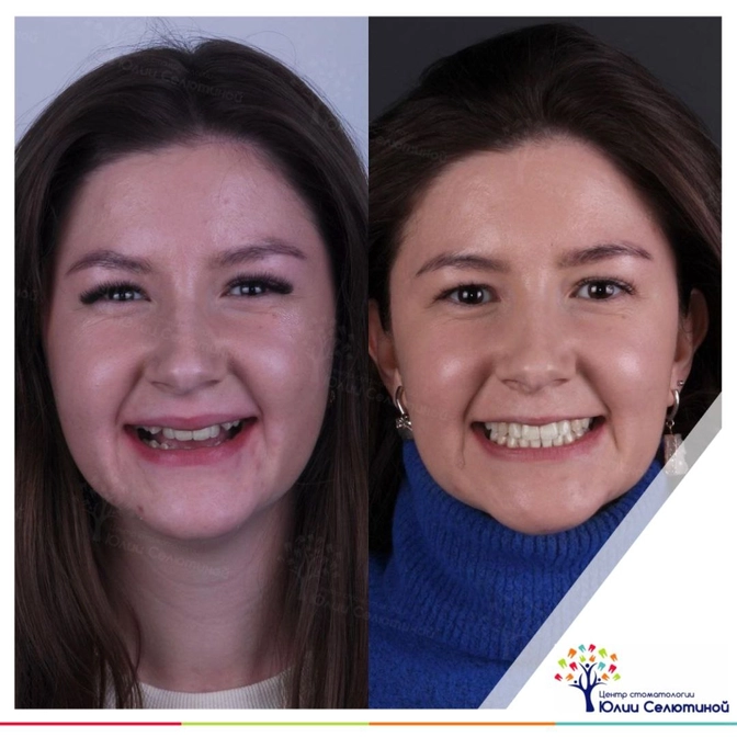 Ортолечение и молодость 