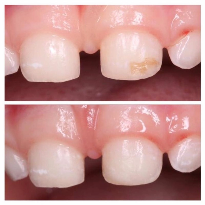 Клинический случай: лечение кариеса без анестезии.