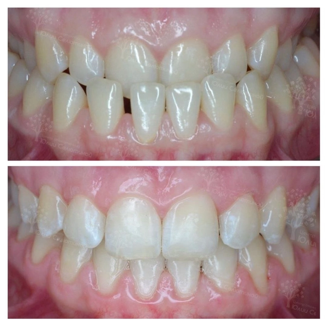 Исправление прикуса: как это повлияло на внешность? 