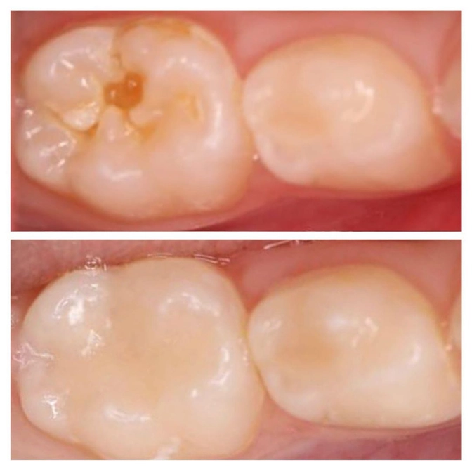 Лечение кариеса 