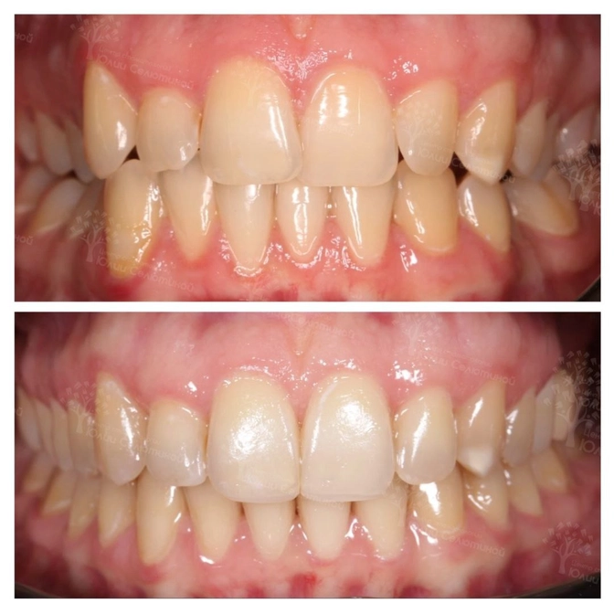 Результат лечения на брекет-системе 