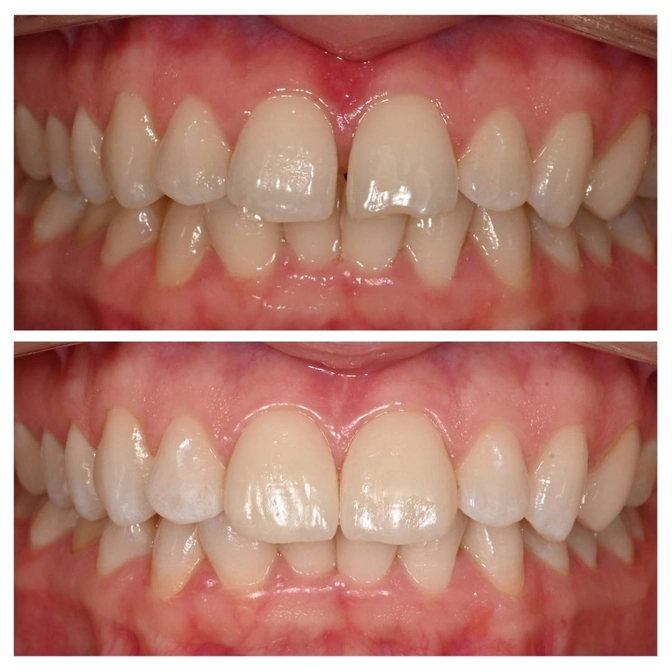 Два винира - новая улыбка. 