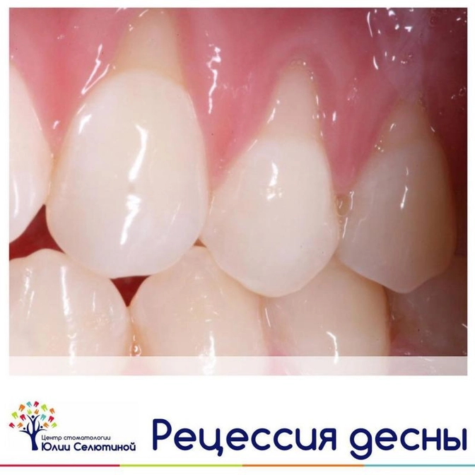 Рецессия десны: причины,лечение, профилактика.