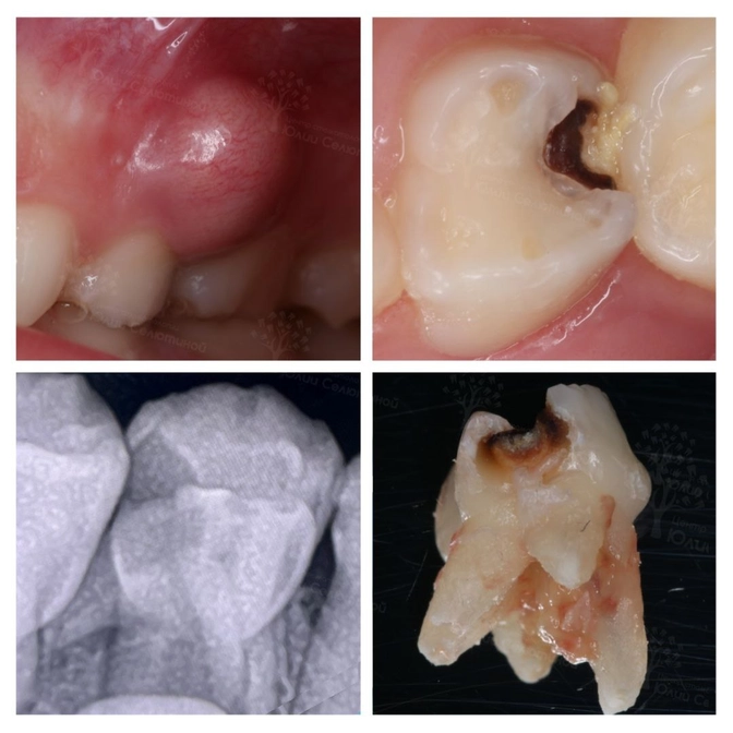 Что делать, если появился свищ над молочным зубом?