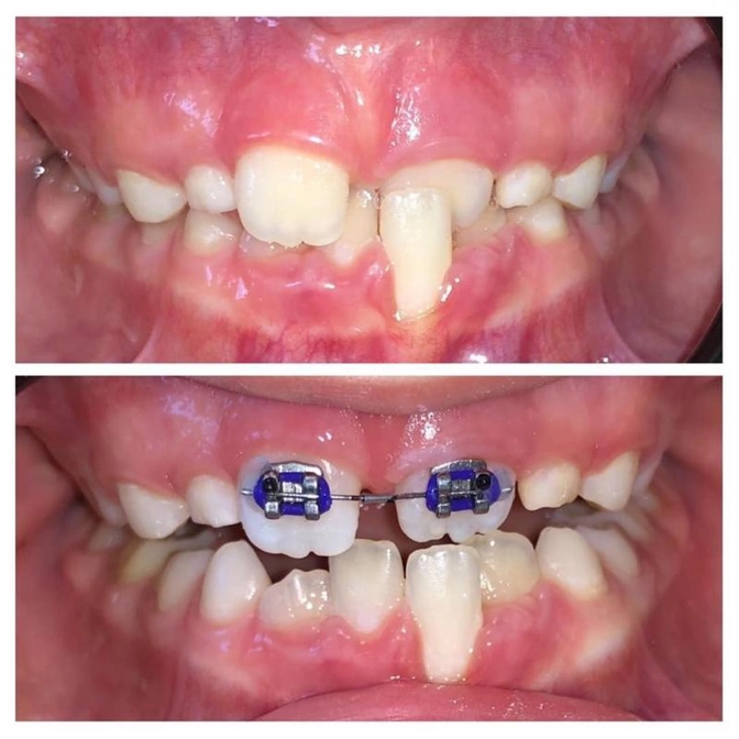 Ортодонтический случай в сменном прикусе