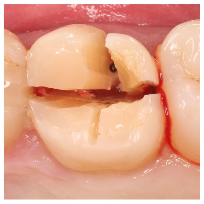 Почему я говорю, что депульпированный зуб обязательно необходимо покрывать коронкой?