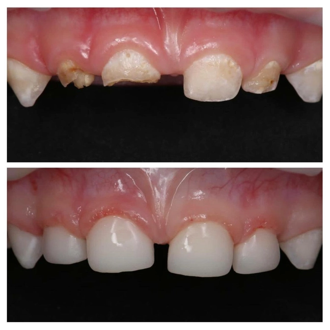 Как быстро прогрессирует кариес раннего детского возраста?