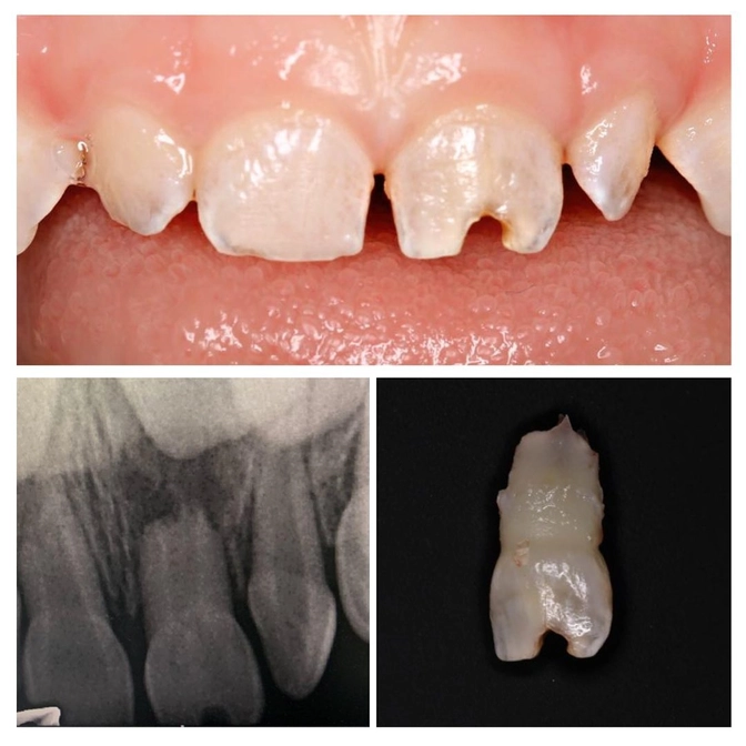 Что бывает после травмы молочного зуба