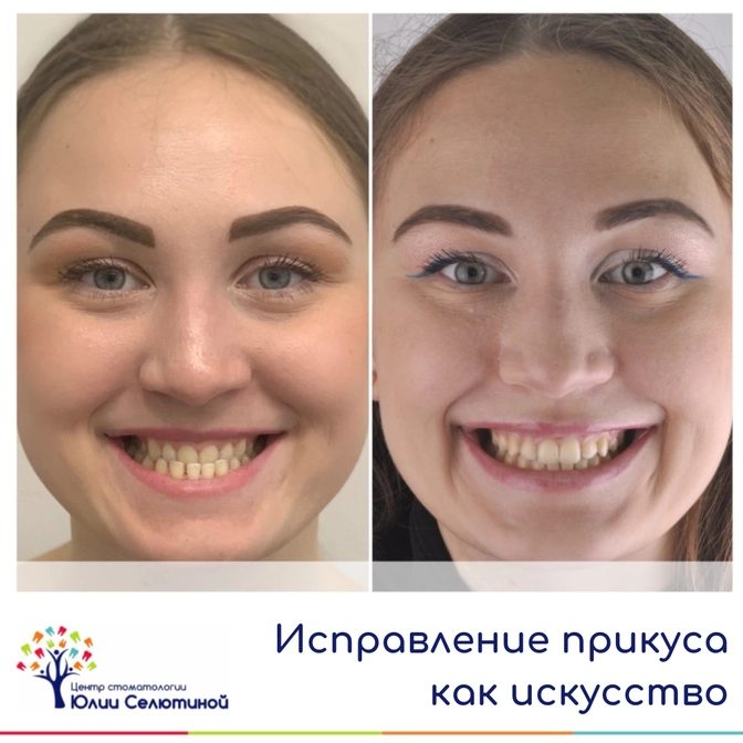 Исправляем прикус - возвращаемся молодость 