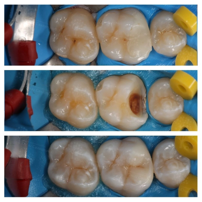 Вторичный кариес