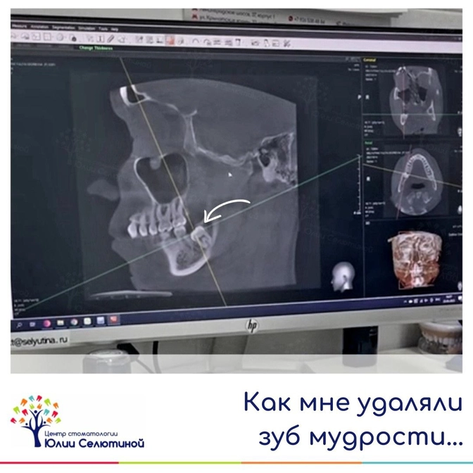 Как мне удаляли зуб мудрости