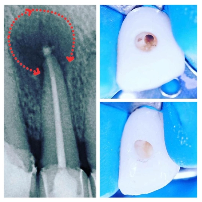 Киста: лечение. 