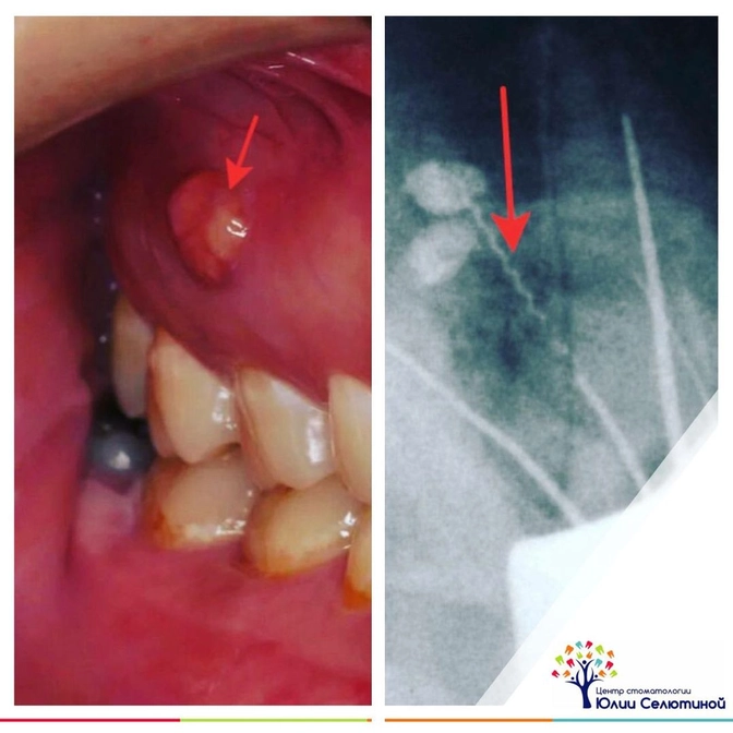 Клинический случай: обломок инструмента в канале зуба.