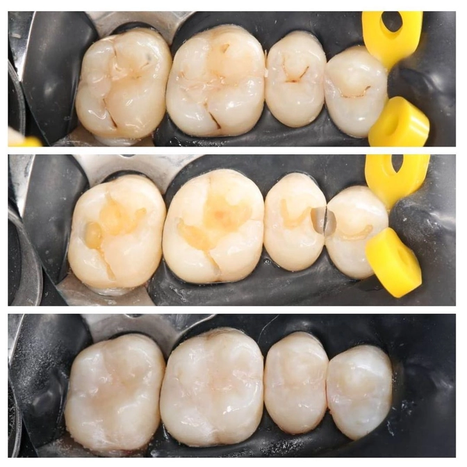 Лечение нескольких зубов в одно посещение.