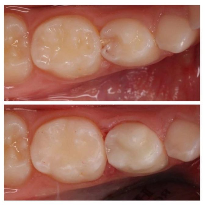 Как быстро прогрессирует кариес