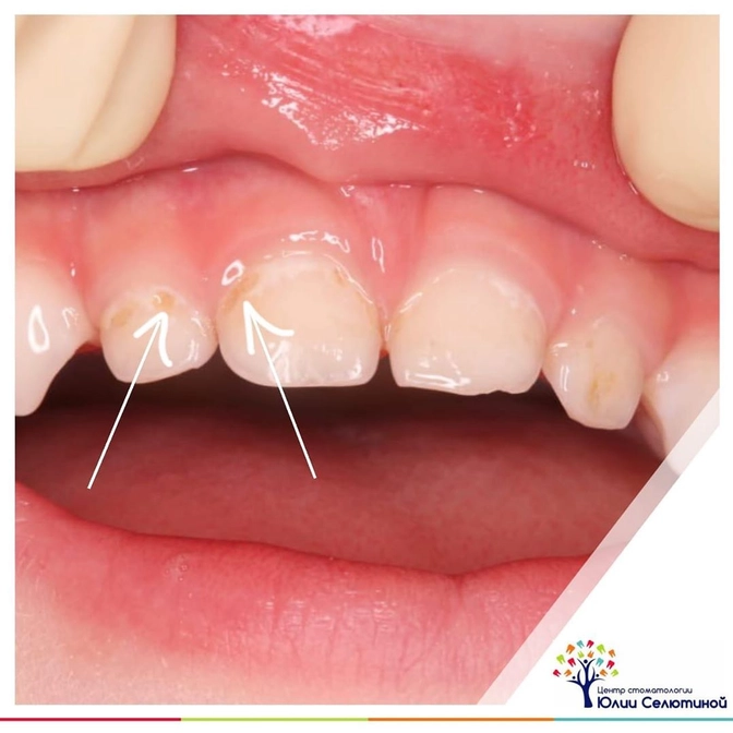 Кариес раннего детского возраста  