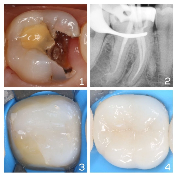 Очередное перелечивание "резорциненного" зуба