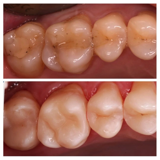 Замена старых пломб 