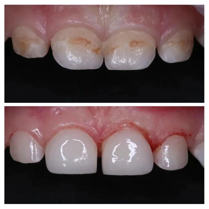 Лечение кариеса у малыша в условиях наркоза 