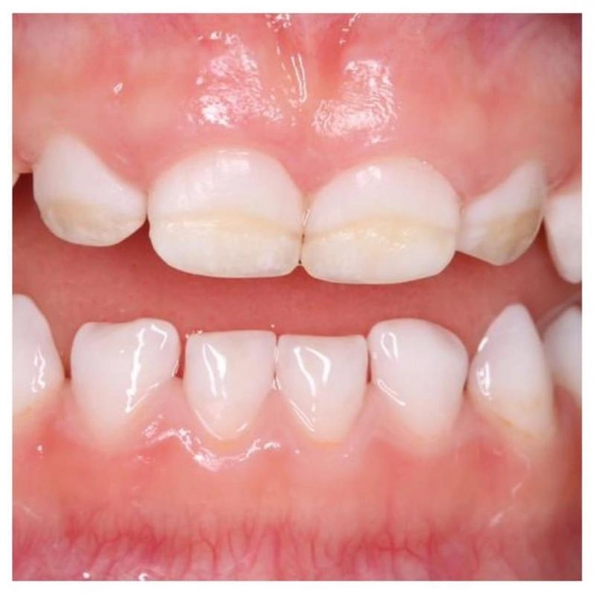 Глубокое фторирование зубов.