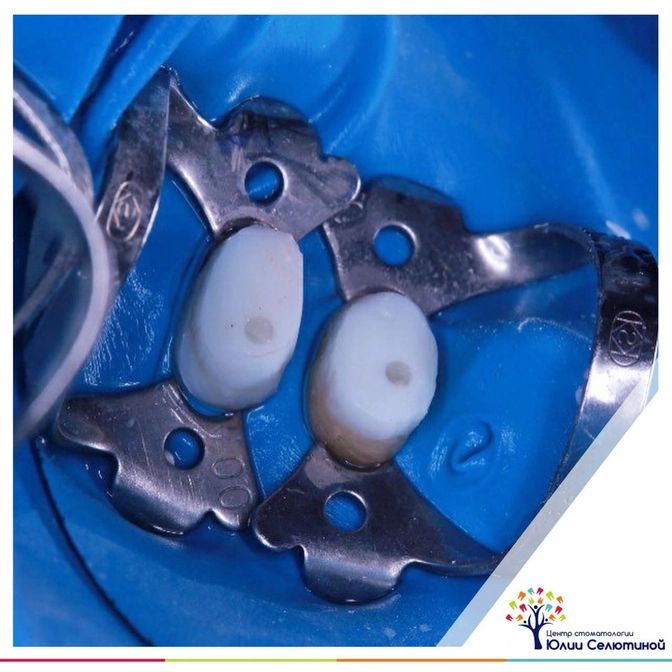 Build-up: техника восстановления сильно разрушенных зубов 