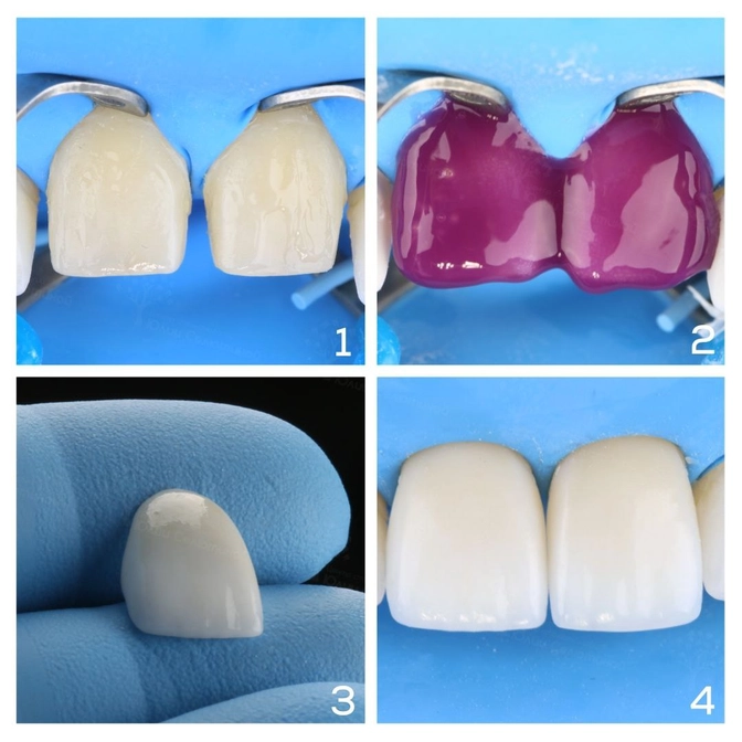 Как фиксируются виниры? 