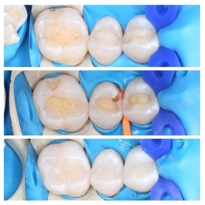 Замена нескольких старых пломб в одно посещение.