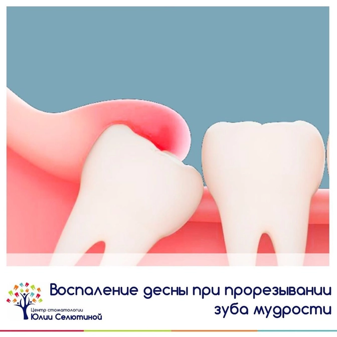 Воспаление десны при прорезывании зубов мудрости